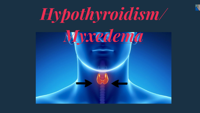 Hypothyroidism/Myxedema by Randi Turner on Prezi