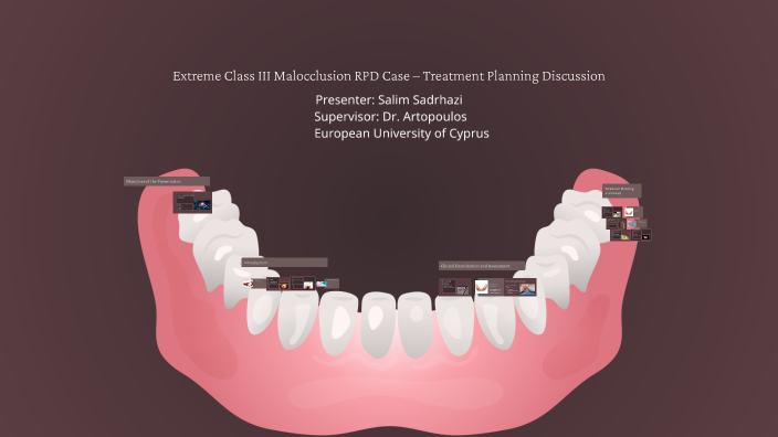 Extreme Class III Malocclusion RPD Case – Treatment Planning Discussion ...