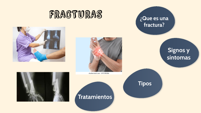 Fracturas By Rocio Paz On Prezi