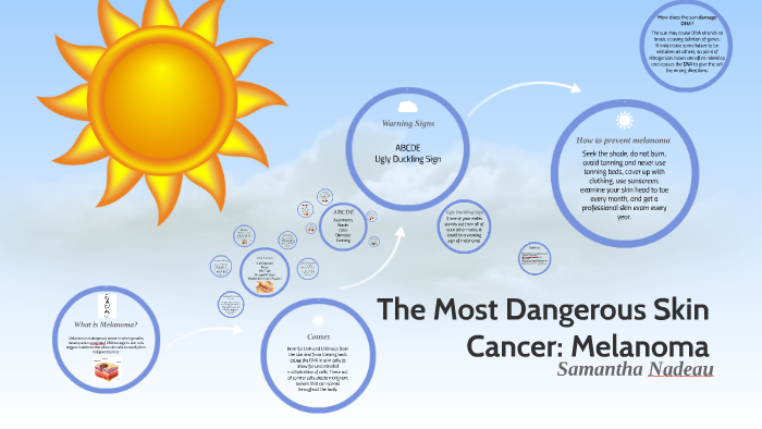 The Most Dangerous Skin Cancer Melanoma By Samantha Nadeau 