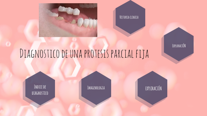 Diagnostico De Una Protesis Parcial Fija By Fatima Zarate On Prezi