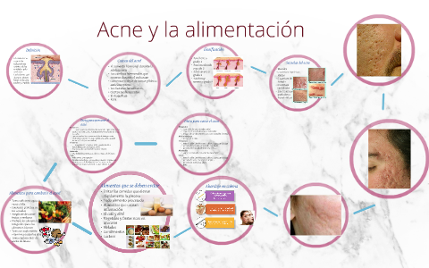 Acne y la alimentación by paty moran chavez on Prezi