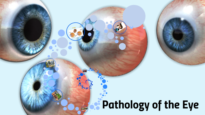 Pathology Of The Eye By Rachelle Bordabehere On Prezi