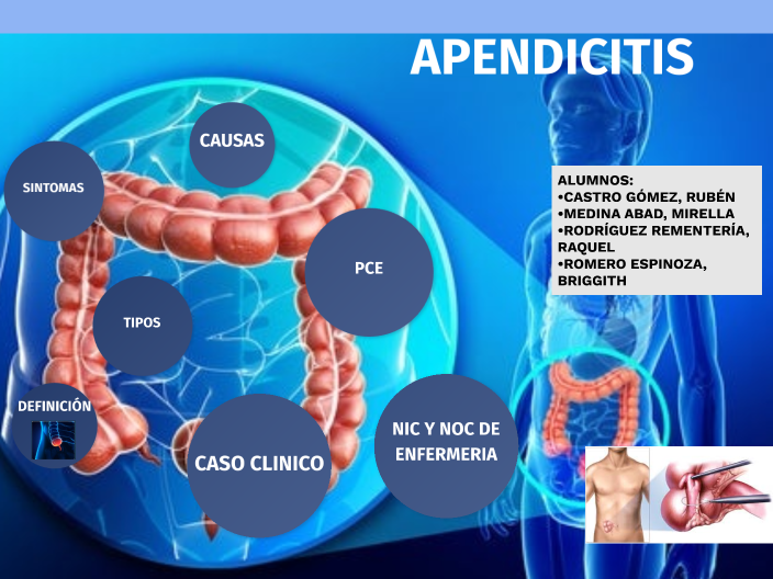 APENDICITIS by Wendi Ancajima Chávez on Prezi