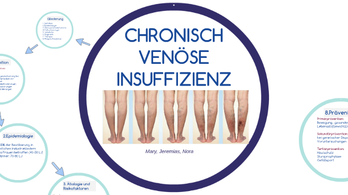 Chronisch Venöse Insuffizienz Stadium 2