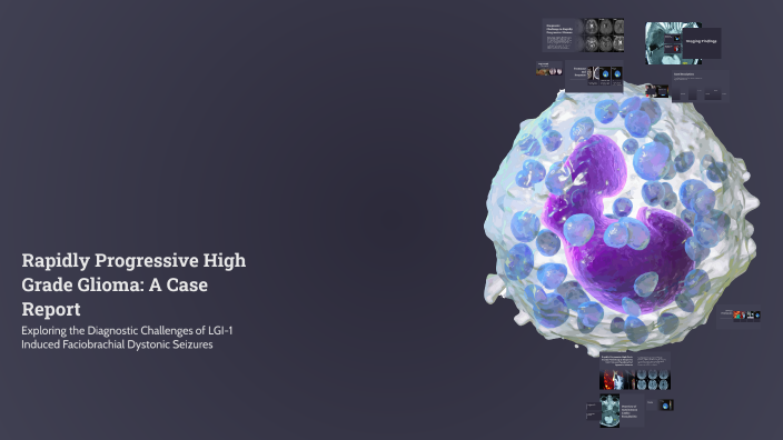 Rapidly Progressive High Grade Glioma: A Case Report by Mehmood Salim ...