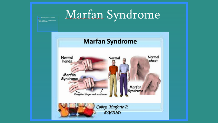 Marfan syndrome by shamar williams on Prezi