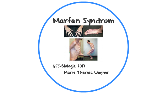 Marfan Syndrom By Gerd Wagner