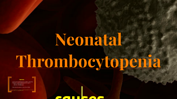 icd 10 code for neonatal thrombocytopenia in newborn