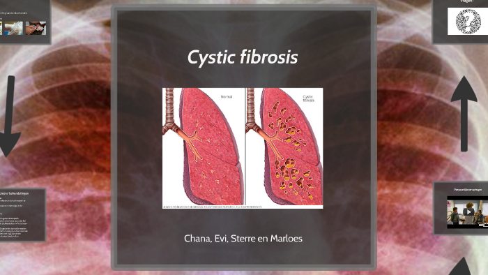 Cystic fibrosis by Marloes de Vries on Prezi