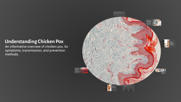 Understanding Chicken Pox by Deepak on Prezi