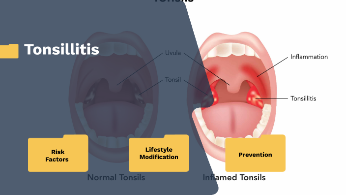 Risk Factors of Tonsillitis by اكمال عليمي on Prezi