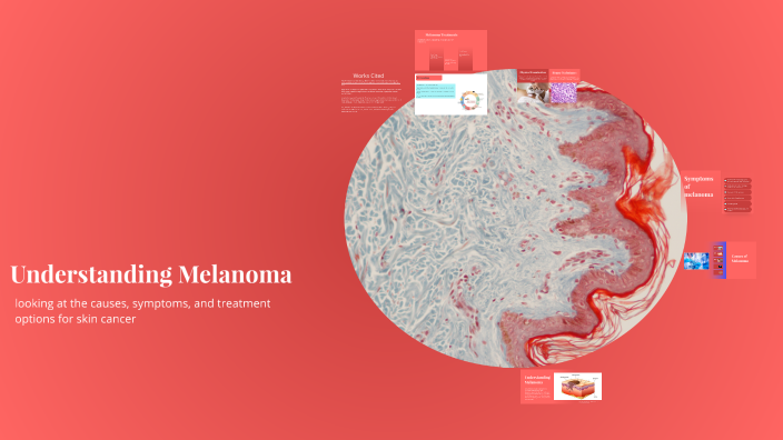 Understanding Melanoma: A Comprehensive Overview by Alexis Wiseman on Prezi