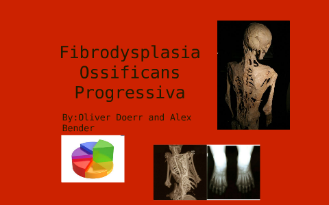 fibrodysplasia ossificans progressiva by Oliver Doerr on Prezi
