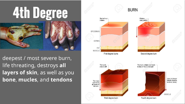 fourth degree burn healing time