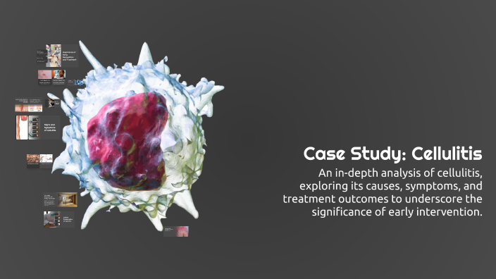 Case Study: Cellulitis by Dianne Negapatan on Prezi