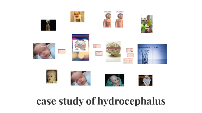 case study on hydrocephalus slideshare