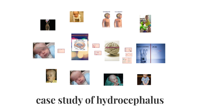 case study on hydrocephalus ppt