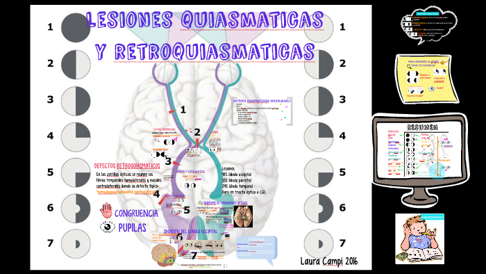 cuadrantanopsia superior