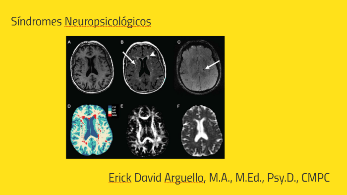 Síndromes Neuropsicológicos By Dr. Erick Argüello On Prezi