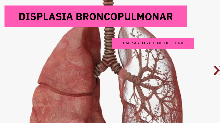 DISPLASIA BRONCOPULMONAR by KAREN YERENE on Prezi
