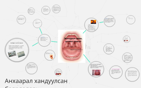 Залгиурын архаг , цочмог үрэвсэл by on Prezi