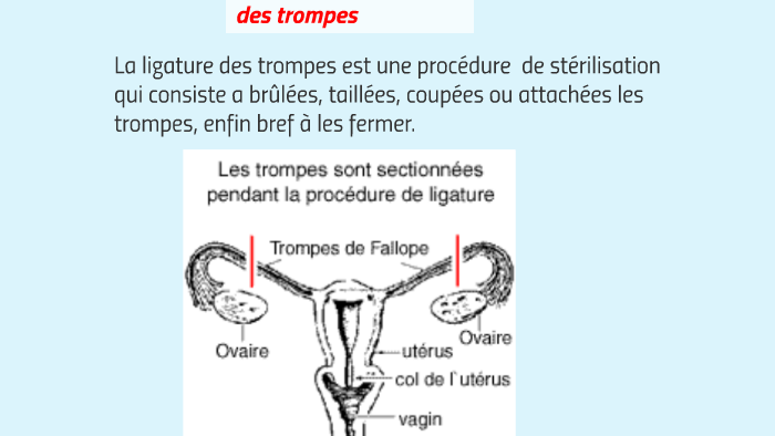 Exposé : La ligature des trompes by jean-pascal piou