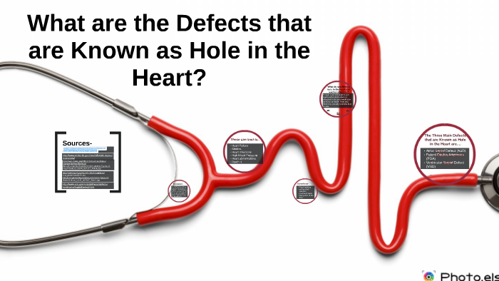 vsd-treatment-in-india-babyheart-in