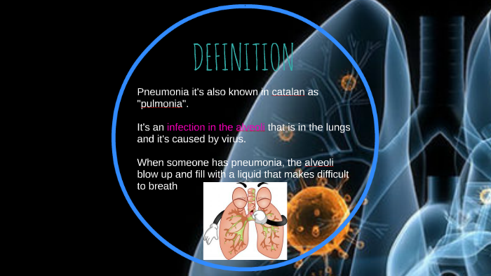 Pneumonia is an inflammatory condition of the lung affecting by Eli ...