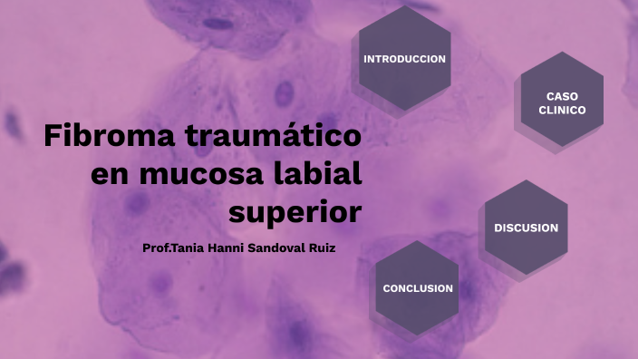 Fibroma Traumático En Mucosa Labial Superior By Elizabeth Hernandez Munguia