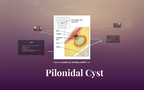 Pilonidal Cyst By Leanna Swanson On Prezi