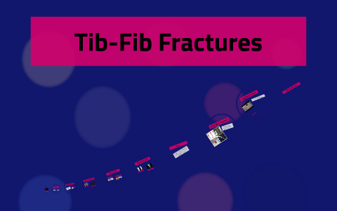 Tib Fib Fracture by Emily Brogan on Prezi