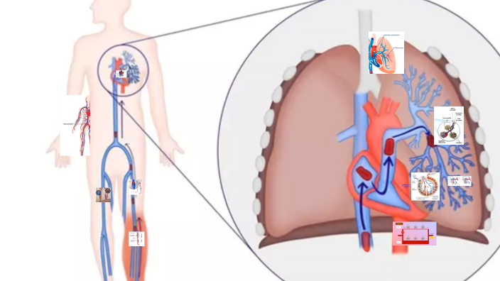 TROMBOEMBOLISMO PULMONAR by Hawer Edinsson Lopez Jimenez on Prezi