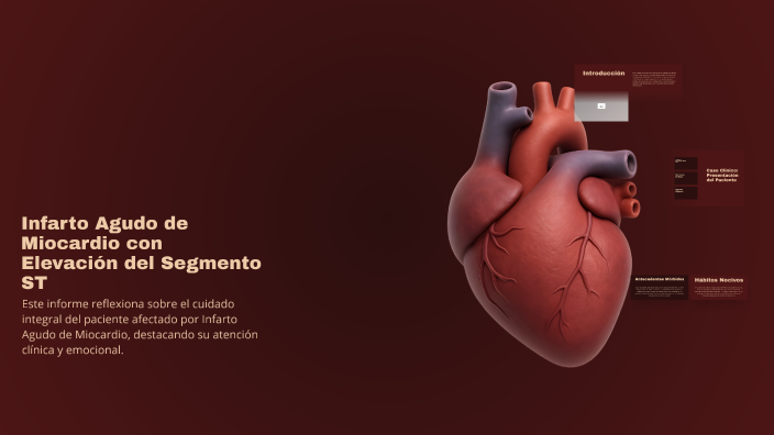 Infarto Agudo de Miocardio con Elevación del Segmento ST by Carol Lazo ...