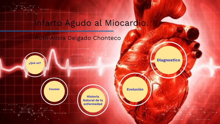 Infarto Agudo al Miocardio (IAM) by RUTH ALICIA CHONTECO on Prezi