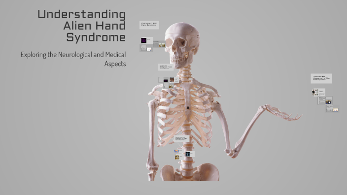 Understanding Alien Hand Syndrome by m m on Prezi