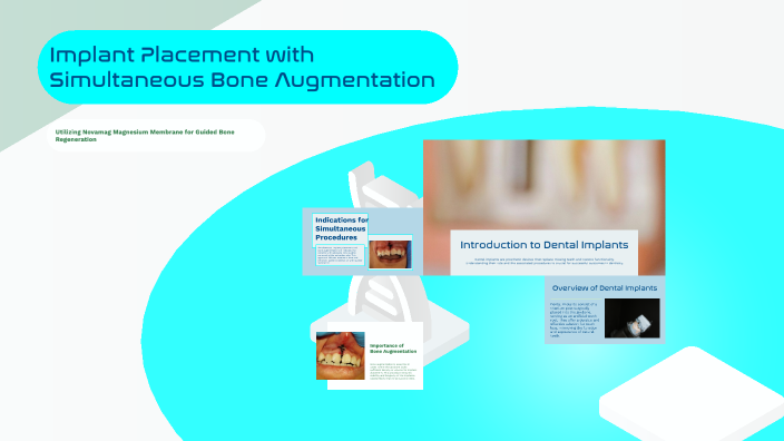Implant Placement with Simultaneous Bone Augmentation by on Prezi