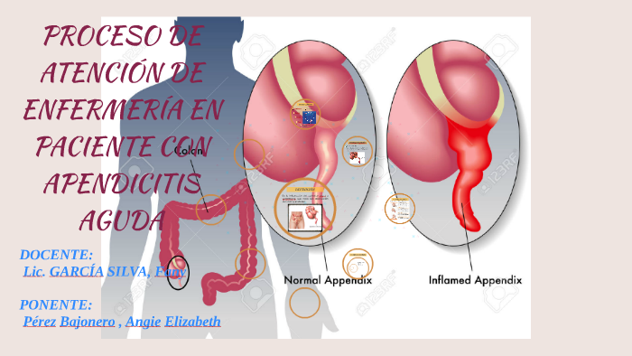 PROCESO DE ATENCIÓN DE ENFERMERÍA CON APENDICITIS AGUDA by Angie Perez