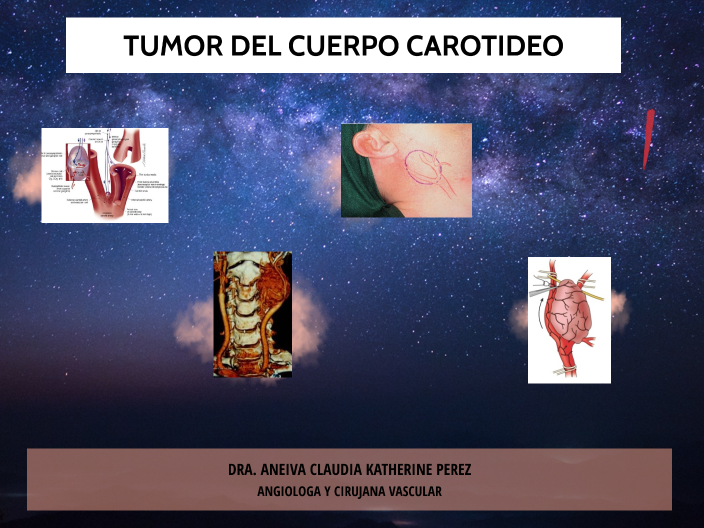 GLOMUS CAROTIDEO by Aneiva Perez on Prezi