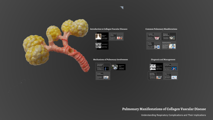 Pulmonary manifestations of collagen vascular disease by Amina Munir on ...