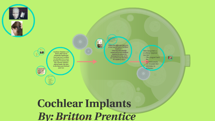 Cochlear Implants By Lindsy Merryfield On Prezi