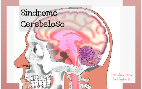 Sindrome Cerebeloso by Erick Flores on Prezi