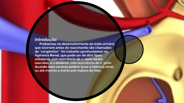 agenesia renal unilateral embriologia