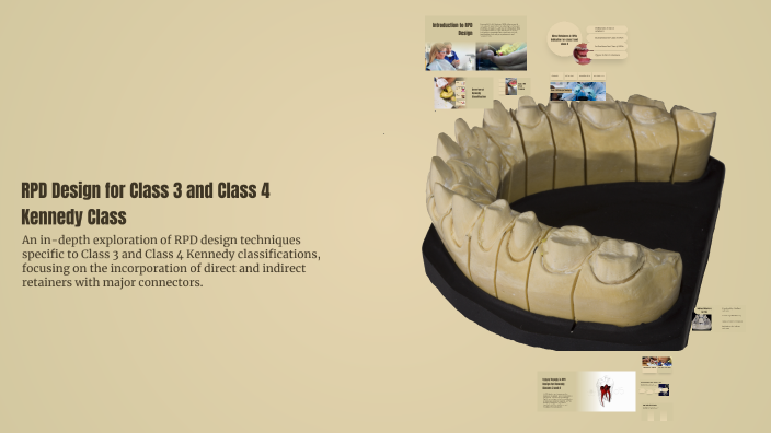 RPD Design for Class 3 and Class 4 Kennedy Class by shouq jneibi on Prezi