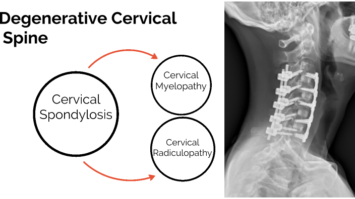 Cervical Spine Degeneration by Nathanael Sbravati on Prezi