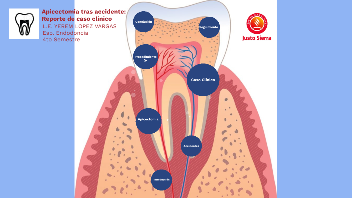 Apicectomia by Yerem LOPEZ on Prezi