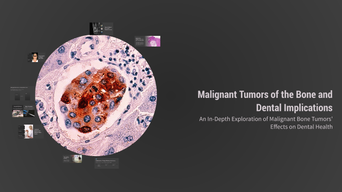 Malignant Tumors of the Bone and Dental Implications by Hased Nased on ...