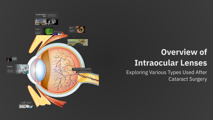Overview of Intraocular Lenses by hanan samy on Prezi