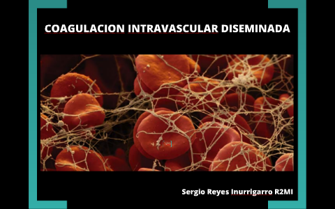 coagulación intravascular diseminada