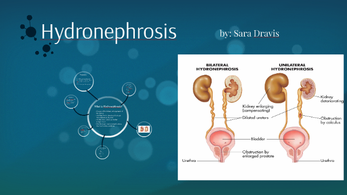 Hydronephrosis Wikidoc